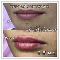 Увеличение и коррекция формы губ