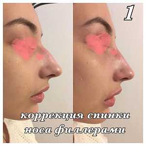 Коррекция спинки носа филлерами